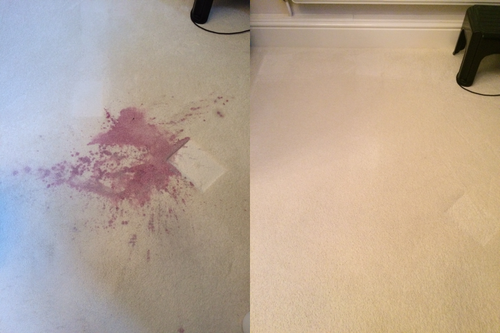 port wine stain removal